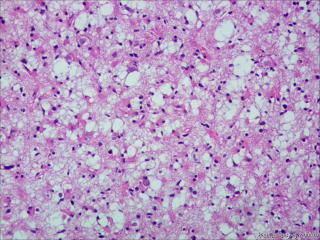 纤维型星形细胞瘤OR肥胖型星形细胞瘤图2