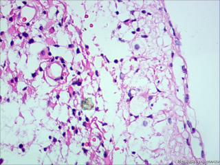纤维型星形细胞瘤OR肥胖型星形细胞瘤图15