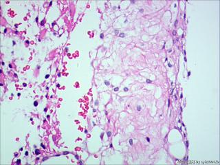 纤维型星形细胞瘤OR肥胖型星形细胞瘤图14