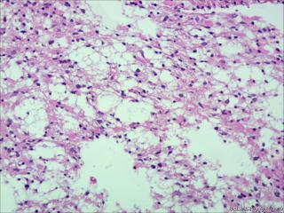 纤维型星形细胞瘤OR肥胖型星形细胞瘤图20