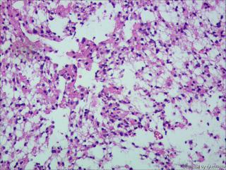 纤维型星形细胞瘤OR肥胖型星形细胞瘤图5