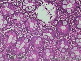 乙状结肠粘膜图46