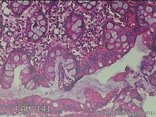 乙状结肠粘膜图17