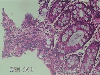 乙状结肠粘膜图34