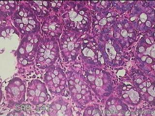 乙状结肠粘膜图22