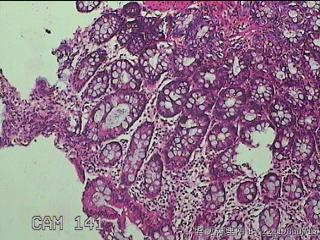 乙状结肠粘膜图5