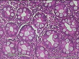 乙状结肠粘膜图45