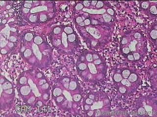 乙状结肠粘膜图50