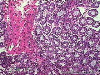 乙状结肠粘膜图3