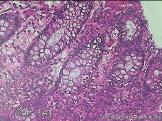 乙状结肠粘膜图39