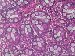 乙状结肠粘膜图44