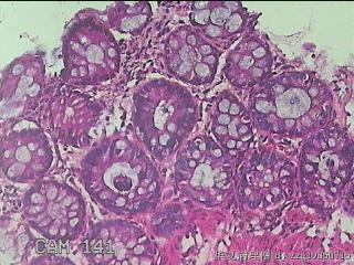 乙状结肠粘膜图28