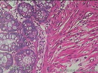 乙状结肠粘膜图29