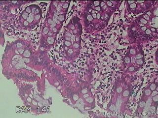 乙状结肠粘膜图33