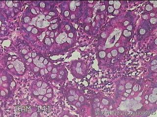 乙状结肠粘膜图16