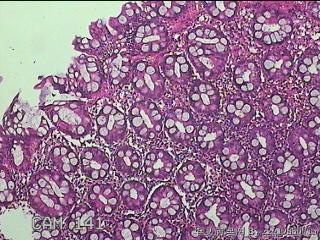 乙状结肠粘膜图12