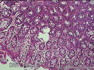 乙状结肠粘膜图4