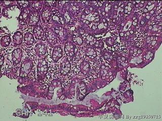 乙状结肠粘膜图2
