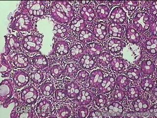 乙状结肠粘膜图13