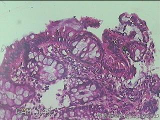 乙状结肠粘膜图37