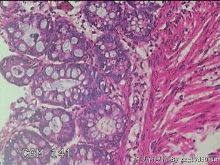 乙状结肠粘膜图36