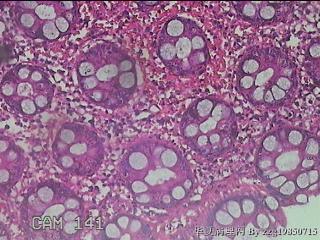 乙状结肠粘膜图43