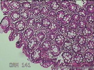 乙状结肠粘膜图14