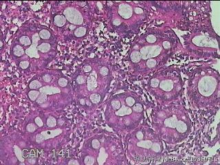乙状结肠粘膜图40