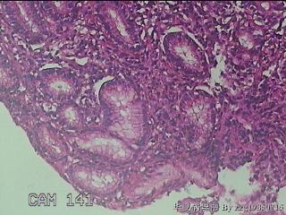 胃窦小弯侧粘膜图30
