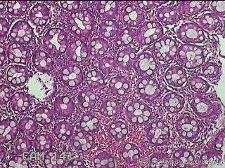 乙状结肠粘膜图11