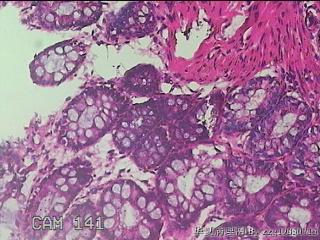 乙状结肠粘膜图31