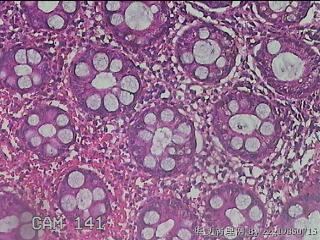 乙状结肠粘膜图42