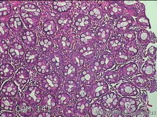 乙状结肠粘膜图10
