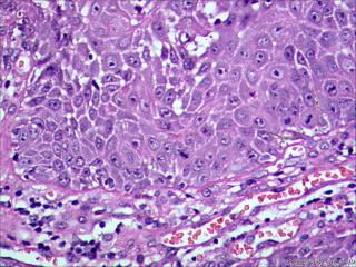 高分化鳞状细胞癌？图2