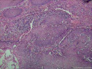 高分化鳞状细胞癌？图10