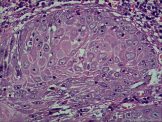 高分化鳞状细胞癌？图12