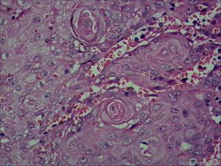 高分化鳞状细胞癌？图8