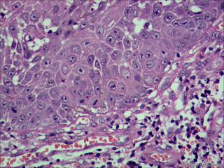 高分化鳞状细胞癌？图13