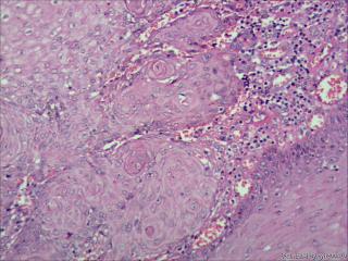 高分化鳞状细胞癌？图6
