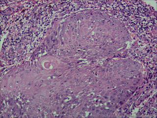 高分化鳞状细胞癌？图11