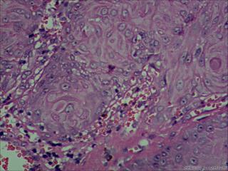 高分化鳞状细胞癌？图9