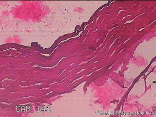 肠系膜赘生物图41