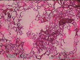 肠系膜赘生物图73