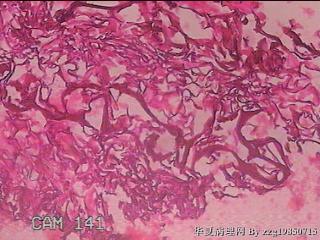 肠系膜赘生物图23