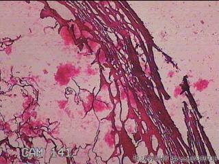 肠系膜赘生物图113