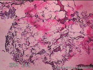 肠系膜赘生物图130