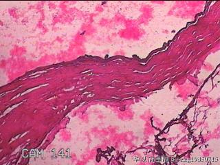 肠系膜赘生物图67