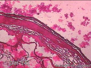 肠系膜赘生物图65