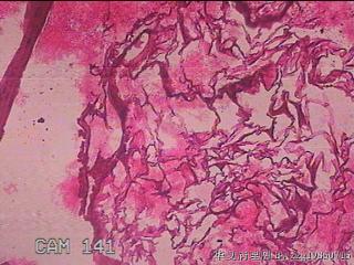 肠系膜赘生物图17