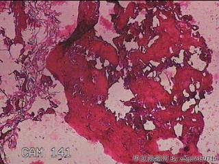 肠系膜赘生物图127